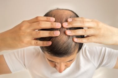 脱毛症の種類や特徴とは？